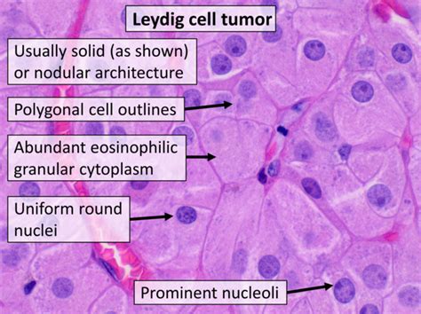 File Histopathology Of Leydig Cell Tumor Of The Ovary High Mag