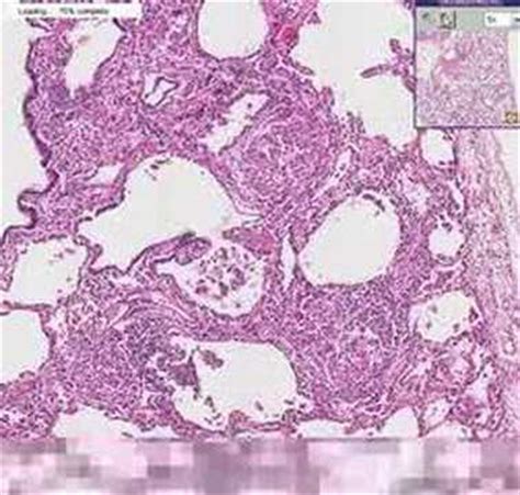 Lung Histology Sarcoidosis