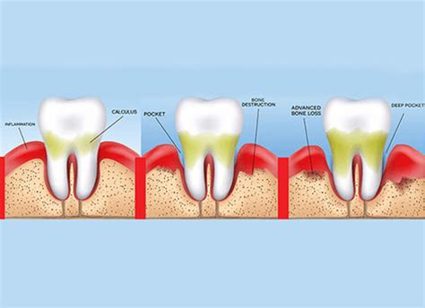 Plaque And Tartar: What They Are And How To Keep Them Under, 60% OFF