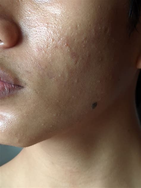 [acne] Is This Closed Comedones R Skincareaddiction