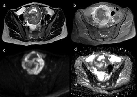 Axial Images Of The Pelvis A T B Post Contrast T Fat Suppressed