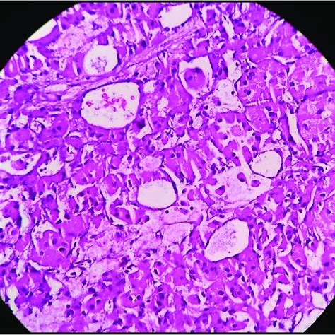 Uniform Organoid Nests Of Polygonal Tumor Cells Separated By