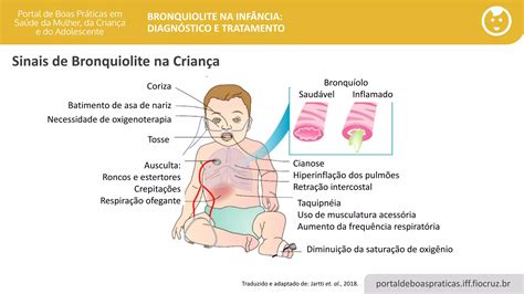 Bronquiolite Na Inf Ncia Diagn Stico E Tratamento Ppt