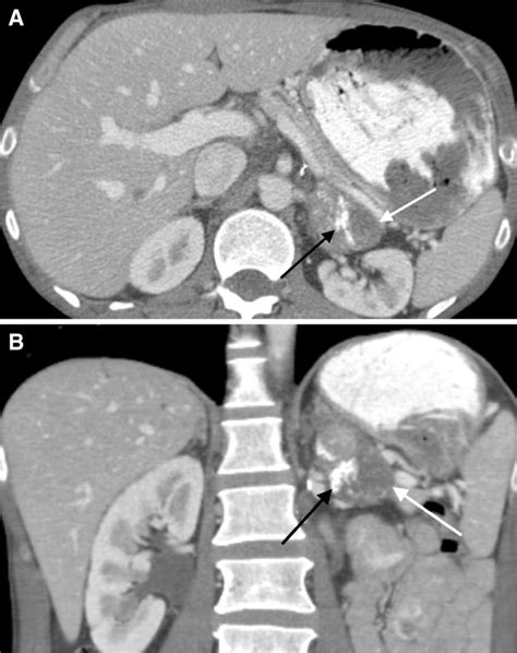 Axial A And Coronal B Contrast Enhanced Ct Images Showing Left