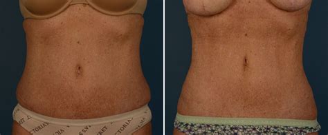 Vaser® Liposuction With Renuvion Photos Naples Fl Patient 25740