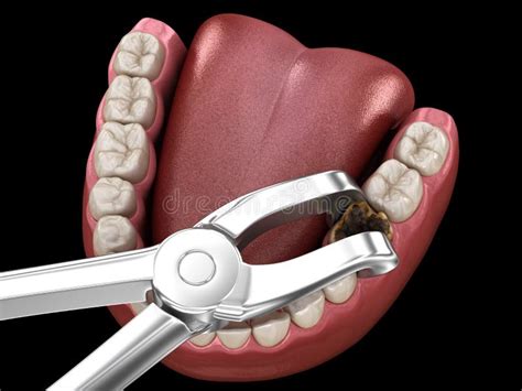 Extraction of Molar Tooth Damaged by Caries. Medically Accurate Tooth ...