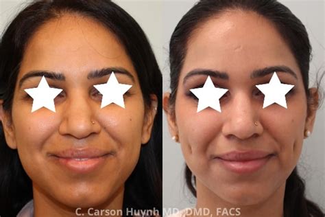 Face Archives Radiance Surgery Aesthetic Medicine