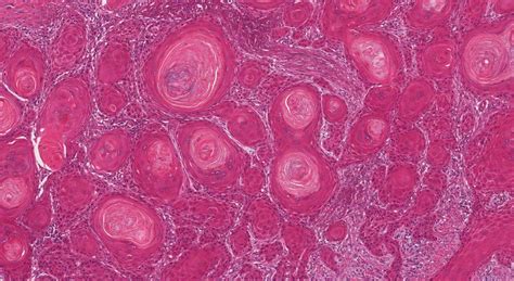 Squamous Cell Carcinoma Of The Larynx Ottawa Atlas Of Pathology