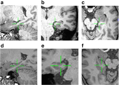 Hippocampal Neuronal Activity Preceding Stimulus Predicts Later Memory ... 