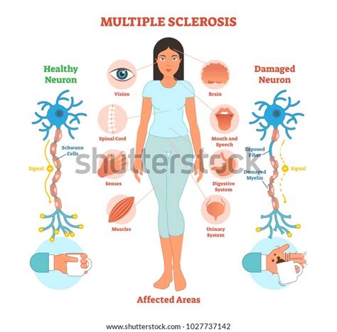 Multiple Sclerosis Anatomical Vector Illustration Diagram Stock Vector Royalty Free 1027737142