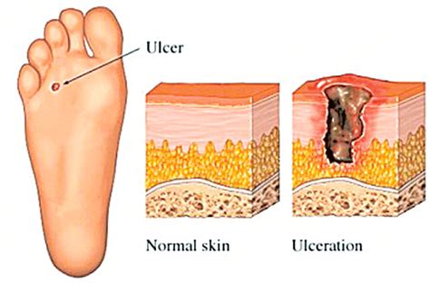 Diabetes and Foot Care: Foot Ulcers - Gluxus Health - COMFORTAID