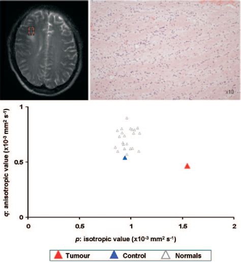 Figure 2 From Improved Delineation Of Glioma Margins And Regions Of