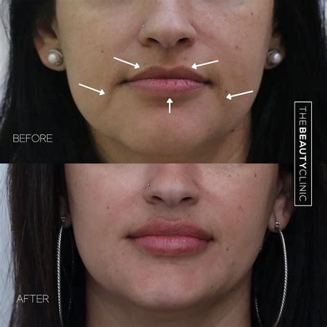 Lower Face Rejuvenation Using Filler And Botox The Beauty Clinic