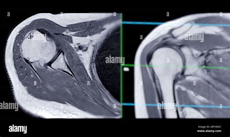 Imagerie Par R Sonance Magn Tique Ou Irm De L Articulation De L Paule