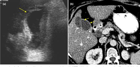 Xanthogranulomatous Cholecystitis Semantic Scholar