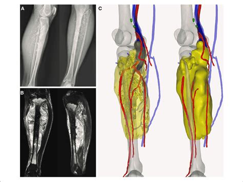 A Preoperative X Ray Indicated The Spindle Shaped Lesion B