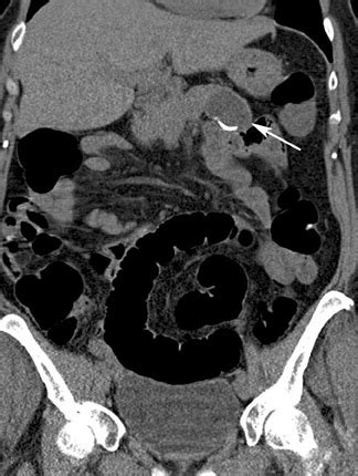 CT colonography: The essentials | Applied Radiology