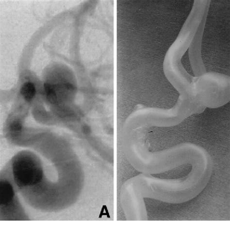 Angiograms Of An Anterior Communicating Artery Aneurysm A And The Download Scientific Diagram