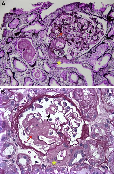 Ajkd Atlas Of Renal Pathology Al Amyloidosis American Journal Of