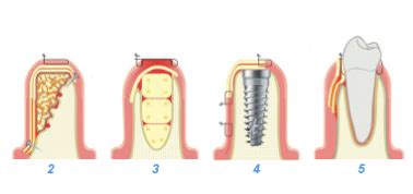 What Does Dental Code D6011 Mean A Comprehensive Guide