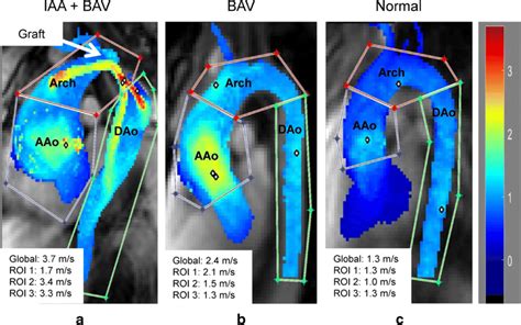 Representative Maximum Intensity Projections Mips Of Aortic Peak