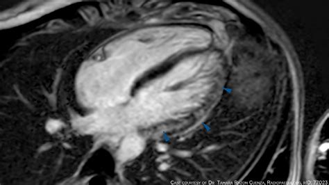 First Close Look At Presumed Myocarditis Cases After COVID Vaccination