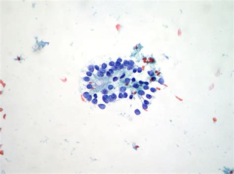 Thyroid Cytopathology