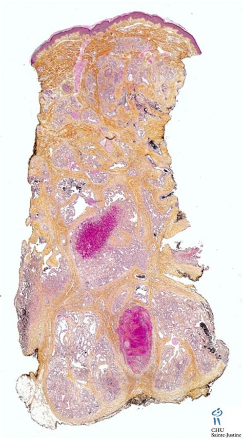 Capillary Hemangiomas Human Pathology Photos Pictures Videos