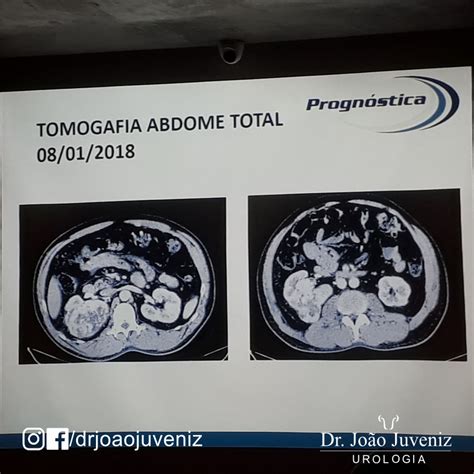 D Dr Joao Juveniz Reuniao Cancer Renal Dr Jo O Juveniz