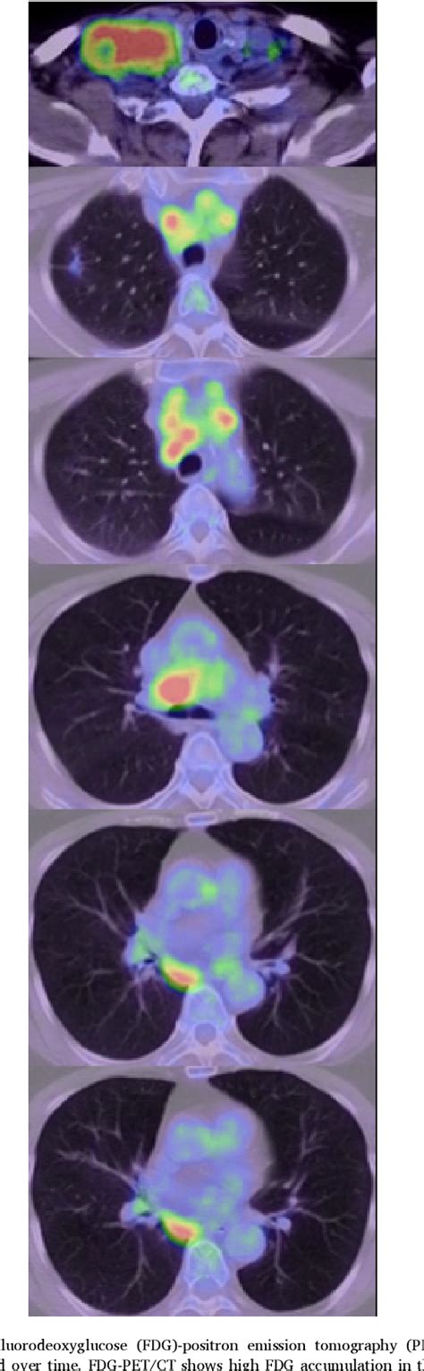 Figure 3 From A Case Of Cervical Lymph Node Tuberculosis And Metastatic