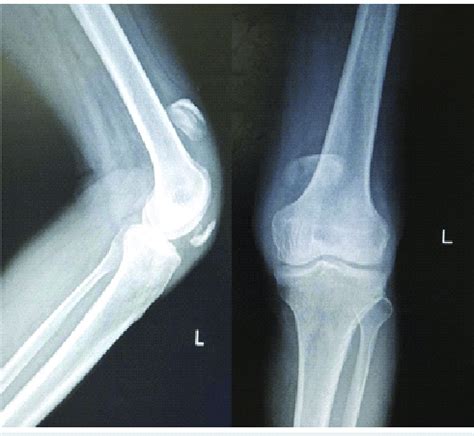 Radiographs of left knee AP and lateral views with patella fracture and... | Download Scientific ...