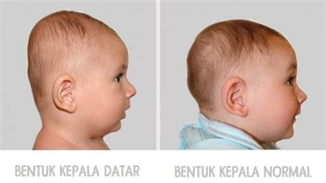 Coba Lihat Kepala Bayi Anda Jika Bentuknya Datar Inilah Yang Akan