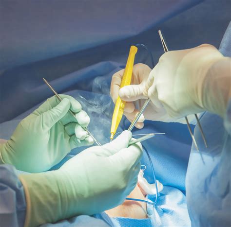 17 States Now Mandate Surgical Smoke Evacuation Outpatient Surgery