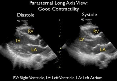 Cardiac Echocardiography Critical Care Clinics