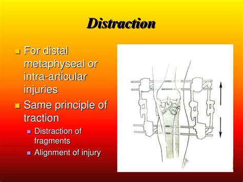 Ppt Fracture Fixation Internal And External Powerpoint Presentation