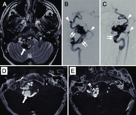 T2 Weighted Magnetic Resonance Imaging A Shows Dilated And Tortuous