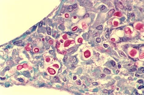 Cryptococcosis Microbewiki