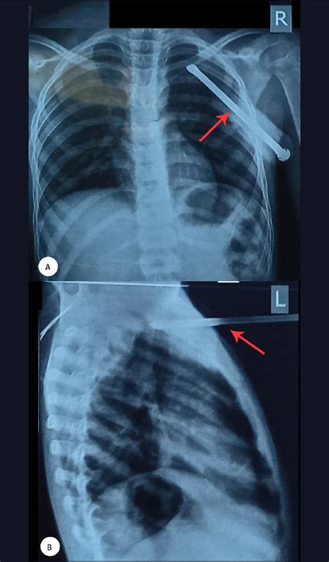 Chest X Rays Of The Patient In Anteroposterior A And Lateral B Views