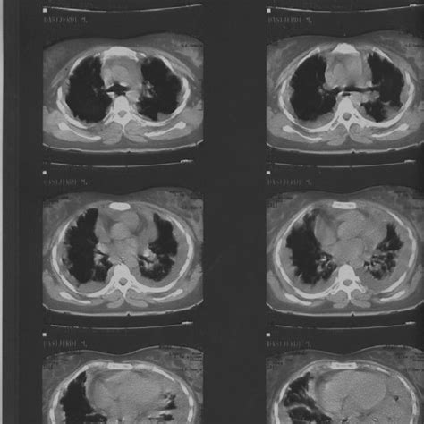 Computed Tomography Scan Shows Bilateral Loculated Pleural Effusions