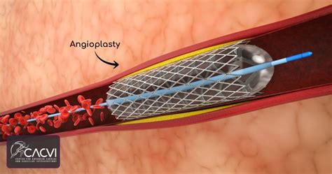 New Treatments For Pad 2024 Cacvi