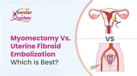 Myomectomy Vs Uterine Fibroid Embolization Which Is Best