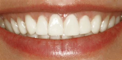 Composite Veneers Sydney Mysmile Dentistry