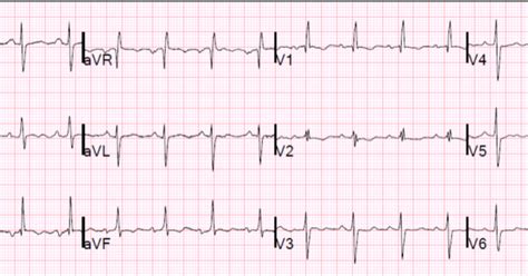 Dr Smiths Ecg Blog Chronic Right Ventricular Hypertrophy Or Acute