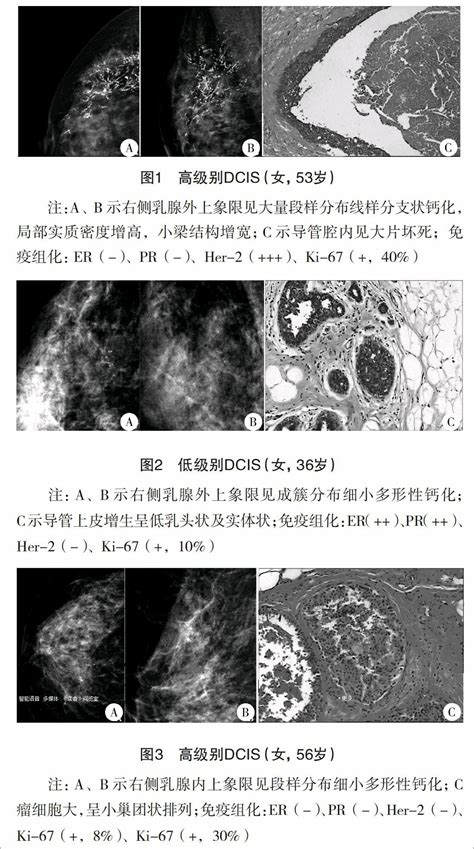 乳腺导管内癌的x线表现与组织病理学、分子分型的对照研究参考网