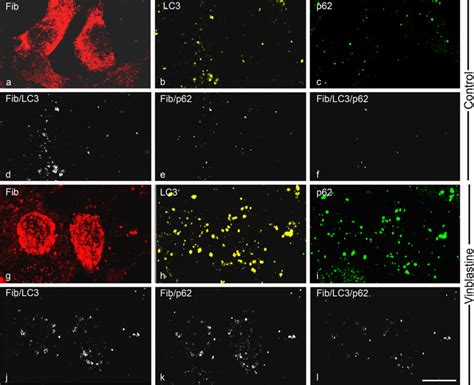 Fibrinogen Partially Colocalizes With Selective Autophagy Cargo