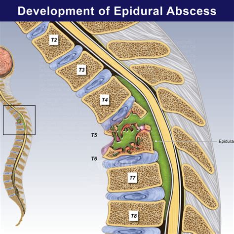 Development Of Epidural Abscess Trialexhibits Inc