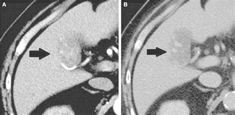 Grade Enhancement A Year Old Male With Elevated Liver Function