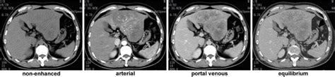 CT scan results 1 month before the surgery. | Download Scientific Diagram