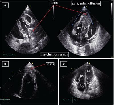 Frontiers Case Report Clinical Features Of Pediatric Acute Myeloid