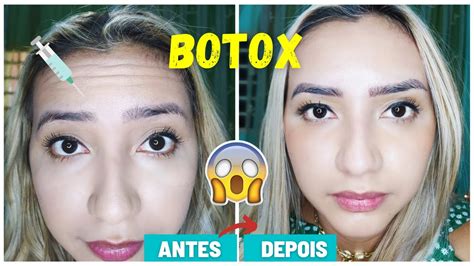 Fiz Botox No Rosto Aos 25 Anos Antes E Depois Quanto Custa Dói